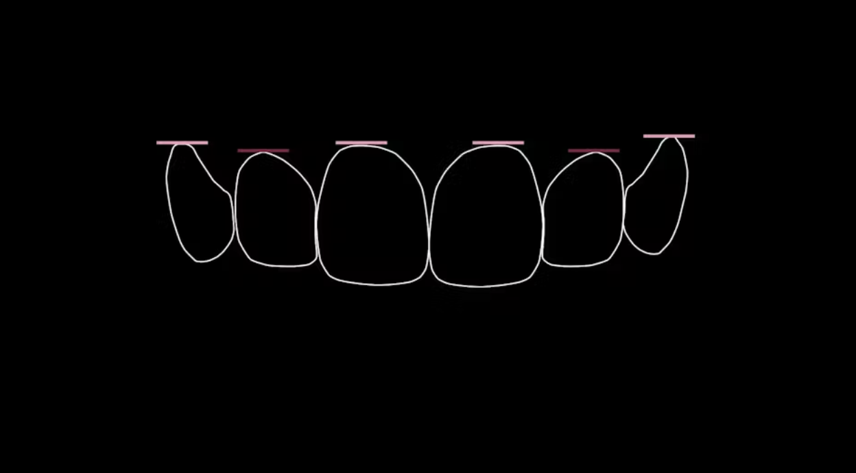 Xác định vị trí đường viền nướu trong thiết kế nụ cười nha khoa